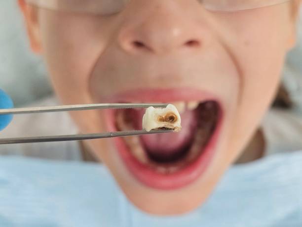 Best Dentist for Tooth Abscess  in Tonkawa, OK